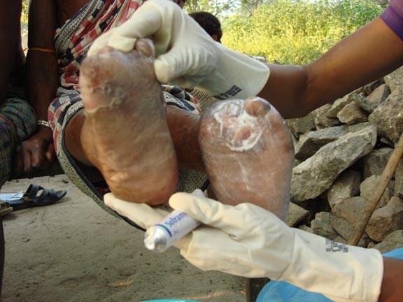 Leprosy Field Report
